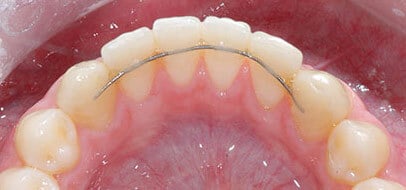 Bonded Retainer Retention After Orthodontics Clear Aligners